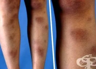 erythema nodosum erythema