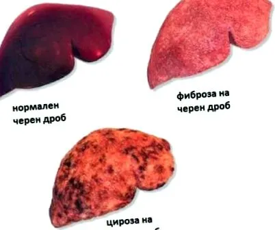 májcirrhosis májcirrhosis