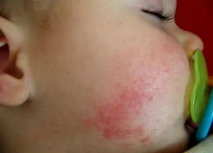 ekcéma