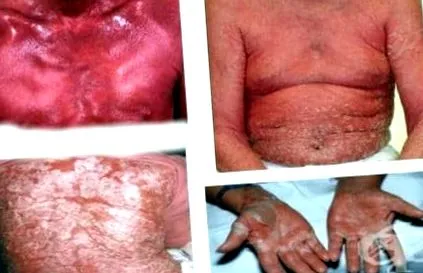 atópiás dermatitis által kiváltott