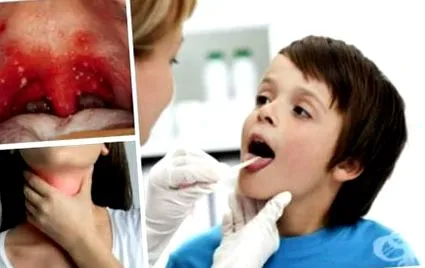 vezikuláris pharyngitis