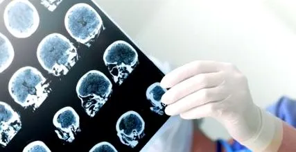 epilepszia gyermekeknél