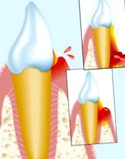 gingivitis gingivitis
