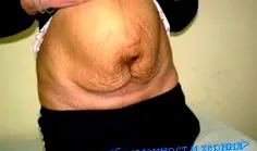 sérv hernia