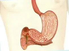 gastroduodenitis duodeno-gastric