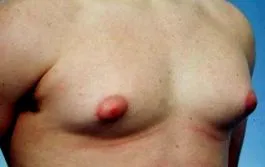 gynecomastia nagy