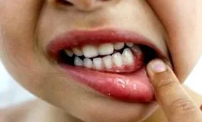 tünetei