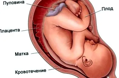 haematoma