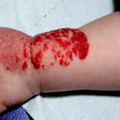 hemangiomas infantilis hemangiomák