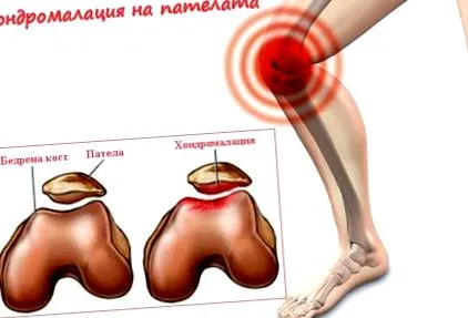 chondromalaciája chondromalaciája