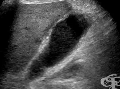 cholecystitis cholecystitis