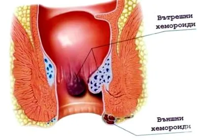 belső aranyér ezen területen