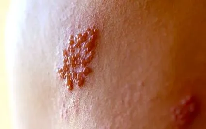 papilloma vírus