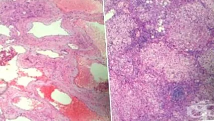 csomói amelyek hemangioma