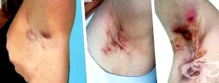 hidradenitis gennyes