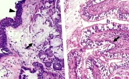 krónikus bronchitis