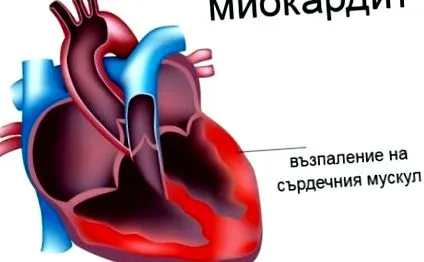 szívizomgyulladás fertőző endocarditis