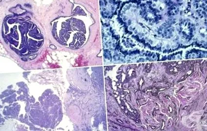 intraductalis papilloma