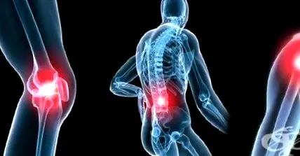 táplálkozás osteoarthritisben