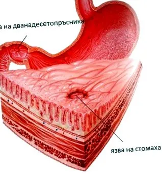 fekély muscularis mucosae