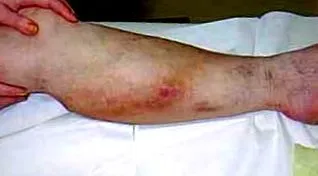 phlebitis