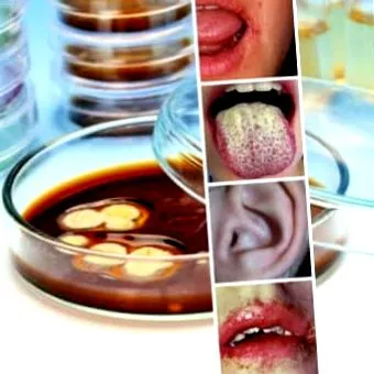 candidiasis