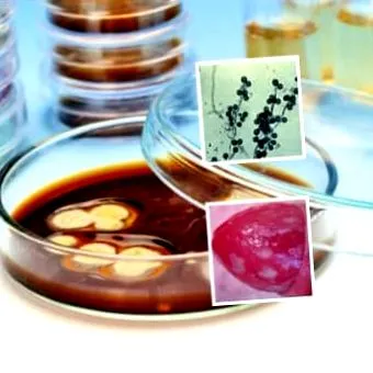 candidiasis