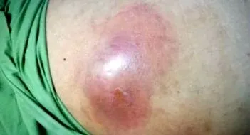 intraabdominális tályogok