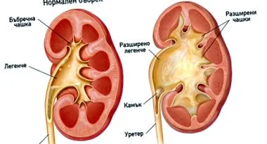 hydronephrosis hydronephrosis