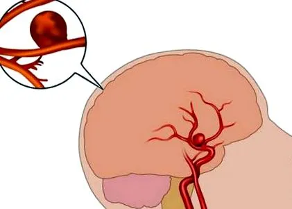 stroke agyi