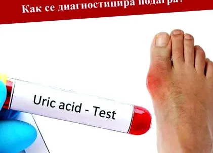 köszvény betegség esetén