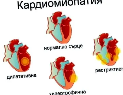 kardiomiopátiában szenvedő kardiomiopátia