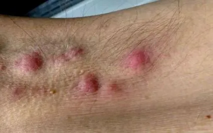 veszélyes hydradenitis