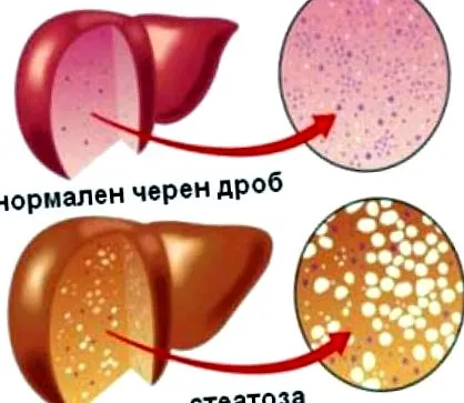 alattomos steatosis