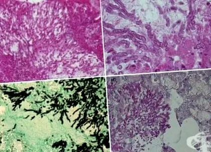 aspergillosis