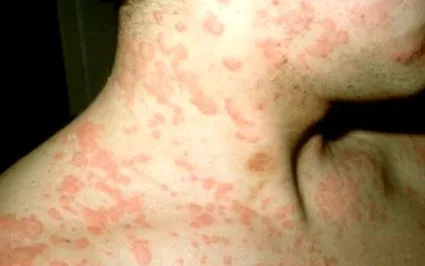 esetben allergiás esetben allergiás