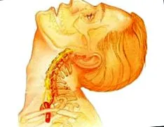 osteochondrosis kezelése kezelése