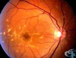 retina leválásának szövődményei
