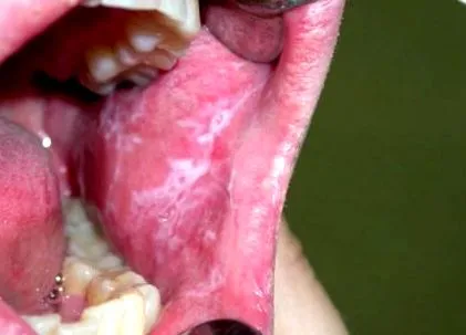 lapos leukoplakia