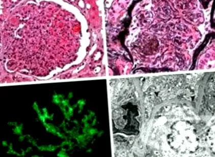 nephrosis lipoid nephrosis