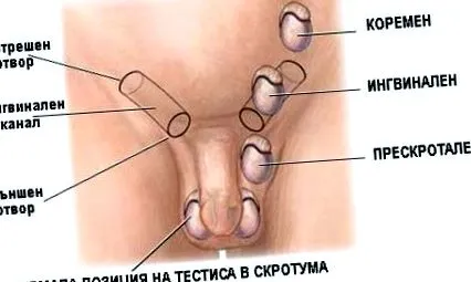 cryptorchidizmus cryptorchidizmus