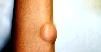 atipikus lipomatosus lipoma