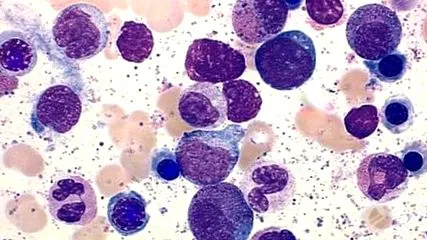 limfoid leukémia limfoid