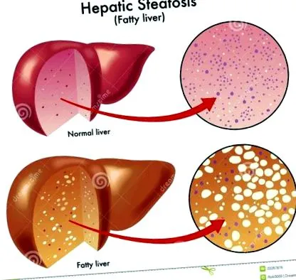 alkoholmentes steatohepatitis
