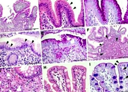 metaplasia patológiája Patológia