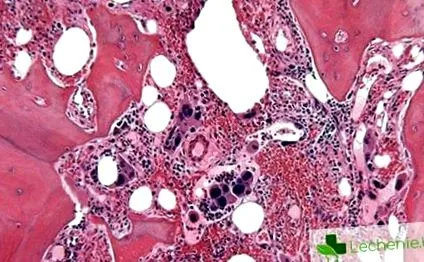 myelofibrosis klinikai vizsgálatok