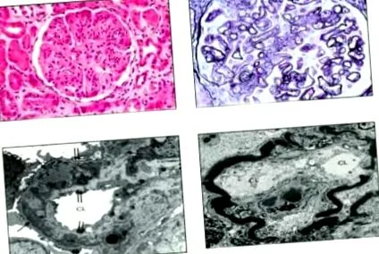 mesangiocapilláris glomerulonephritis mesangiocapilláris glomerulonephritis