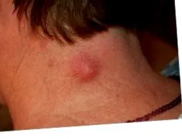 lipoma legjobb