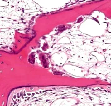 vese osteodystrophiában osteodystrophiában szenvedő