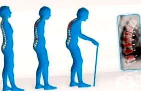 milyen osteoporosis